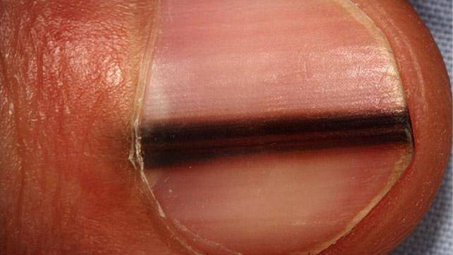 这条黑线出现在你的指甲下面 小心癌症！_ag电竞官网
